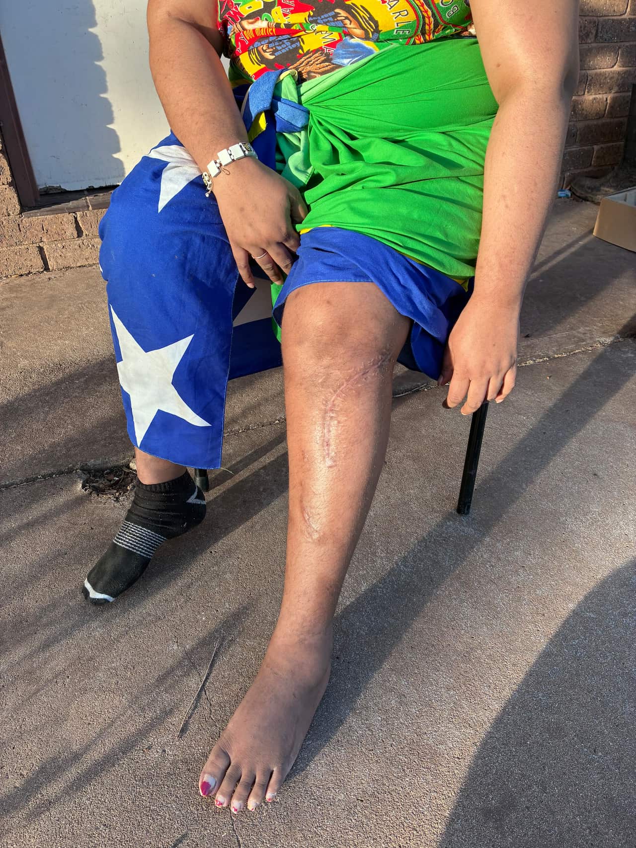 A photograph of a woman's leg bearing scars.