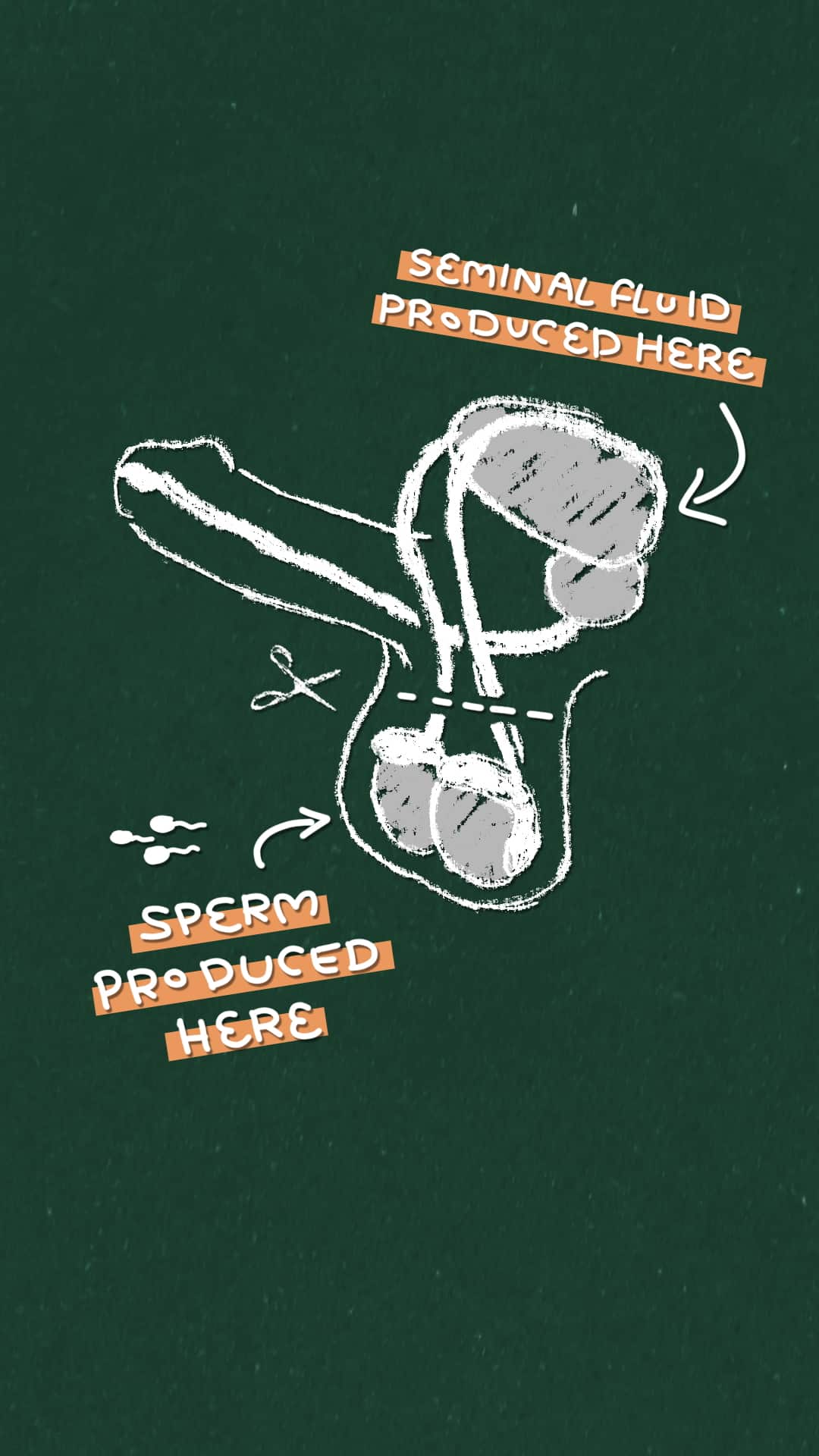 an image showing how a vasectomy works