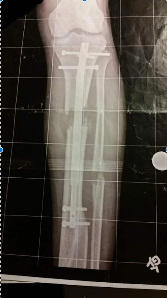 An X-ray of a leg with a lengthening nail implanted.