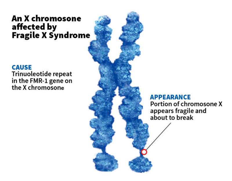 The syndrome was named for the appearance of the affected X chromosome. (Illustration: Scientific American). The syndrome was named for the appearance of the affected X chromosome. (Illustration: Scientific American).