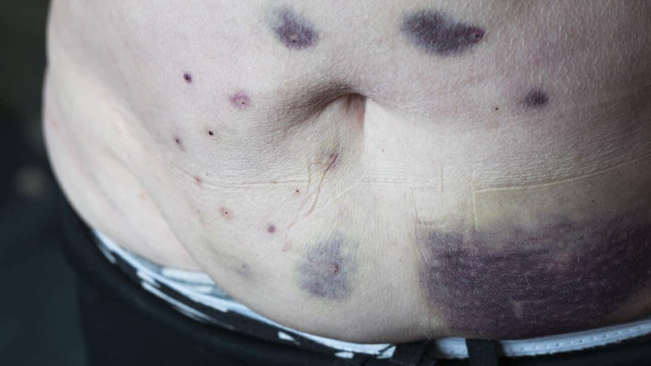 A bruised abdomen