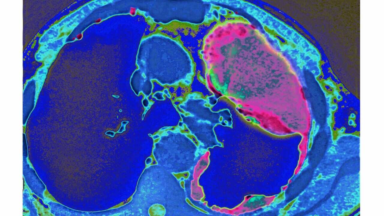 Lung cancer seen on a radial section chest CT scan