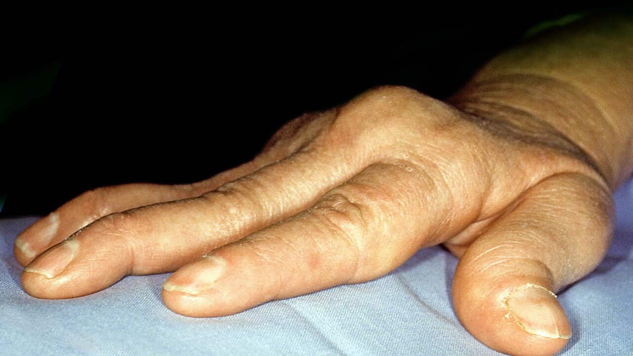 Rheumatoid arthritis