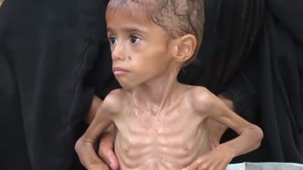 A malnourished child in the Aslam district of the northwestern province of Hajja, Yemen July 30