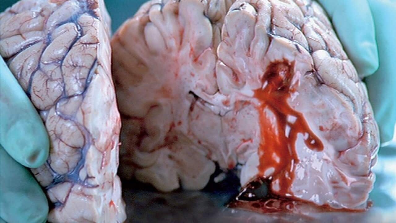 A dissected brain oozing blood after a stroke