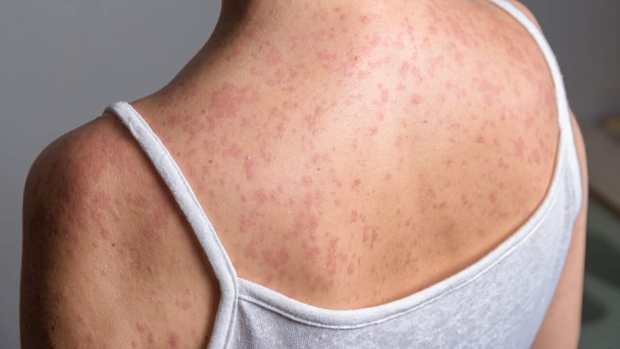 A woman with a red, spotty rash caused by measles.