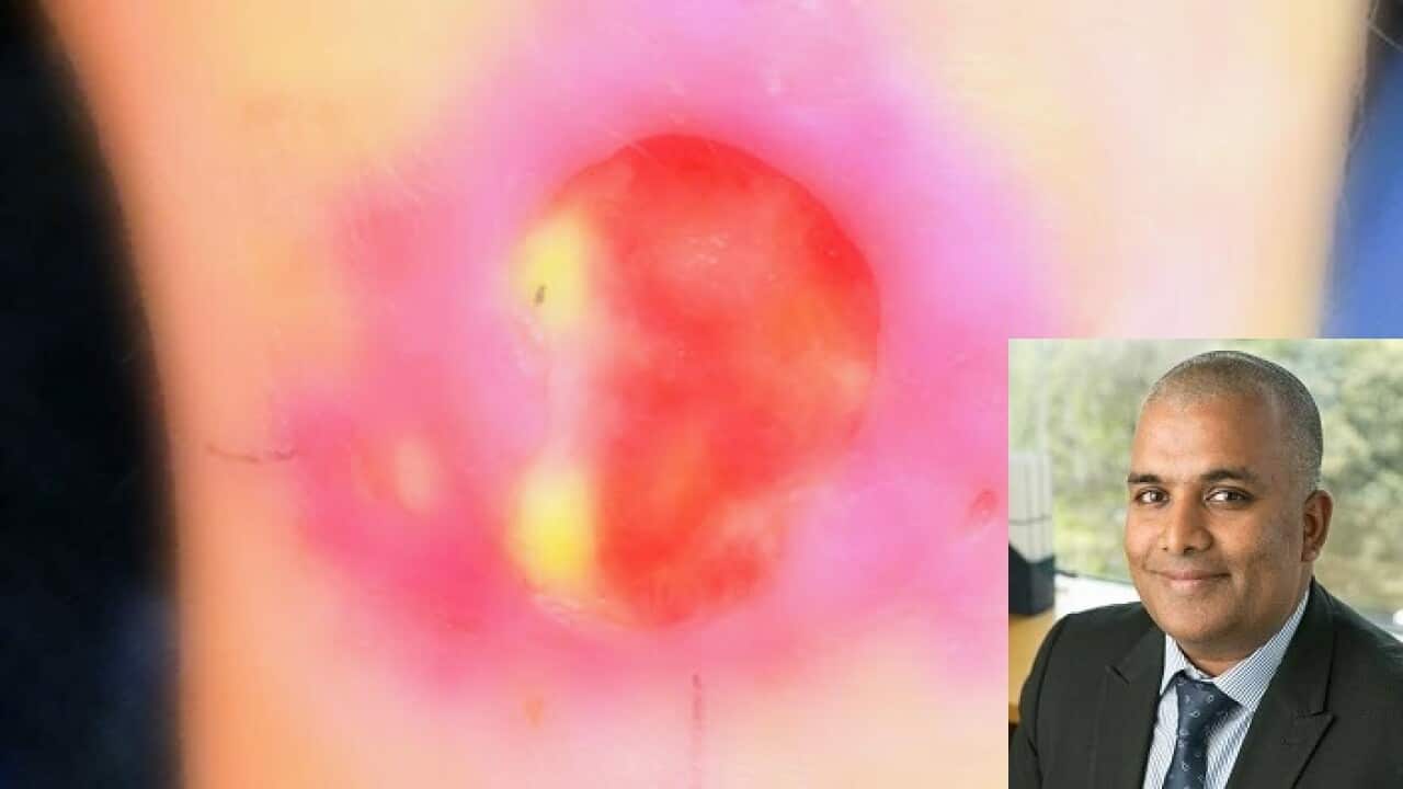 Buruli ulcer