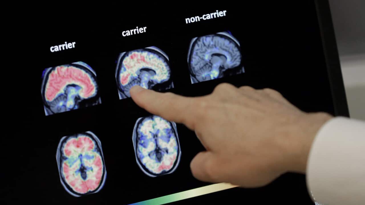 A PET brain scan from a US Alzheimer's Institute (AAP).jpg