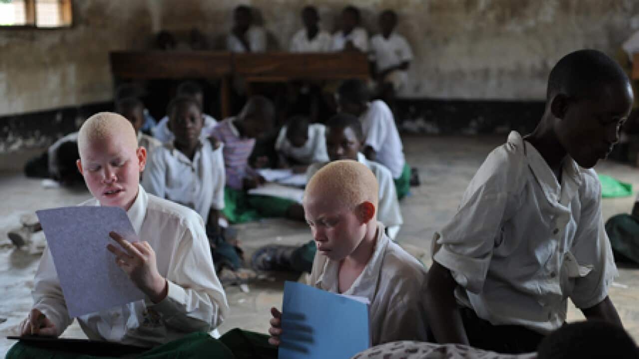 albino_tanzania_AFP_100820_B_960936535