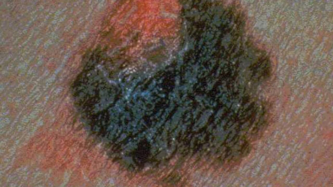Melanoma, a deadly skin cancer