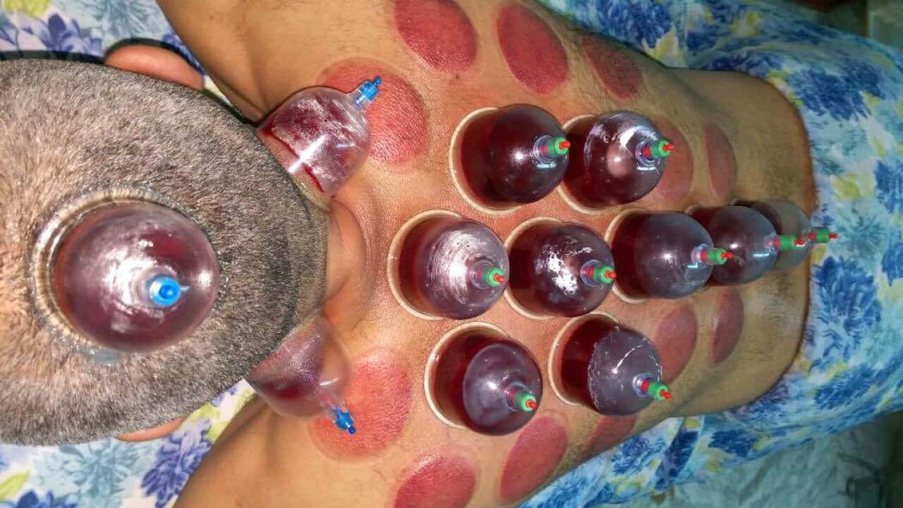 Wet cupping in action in Amman, Jordan. (Cupping Therapy - Amman, Jordan)