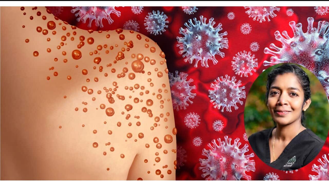 Monkeypox Virus Outbreak as a contagious infection as blisters and leisons on the skin