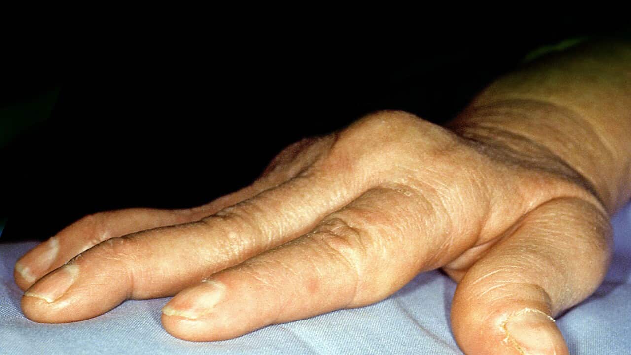 Rheumatoid arthritis