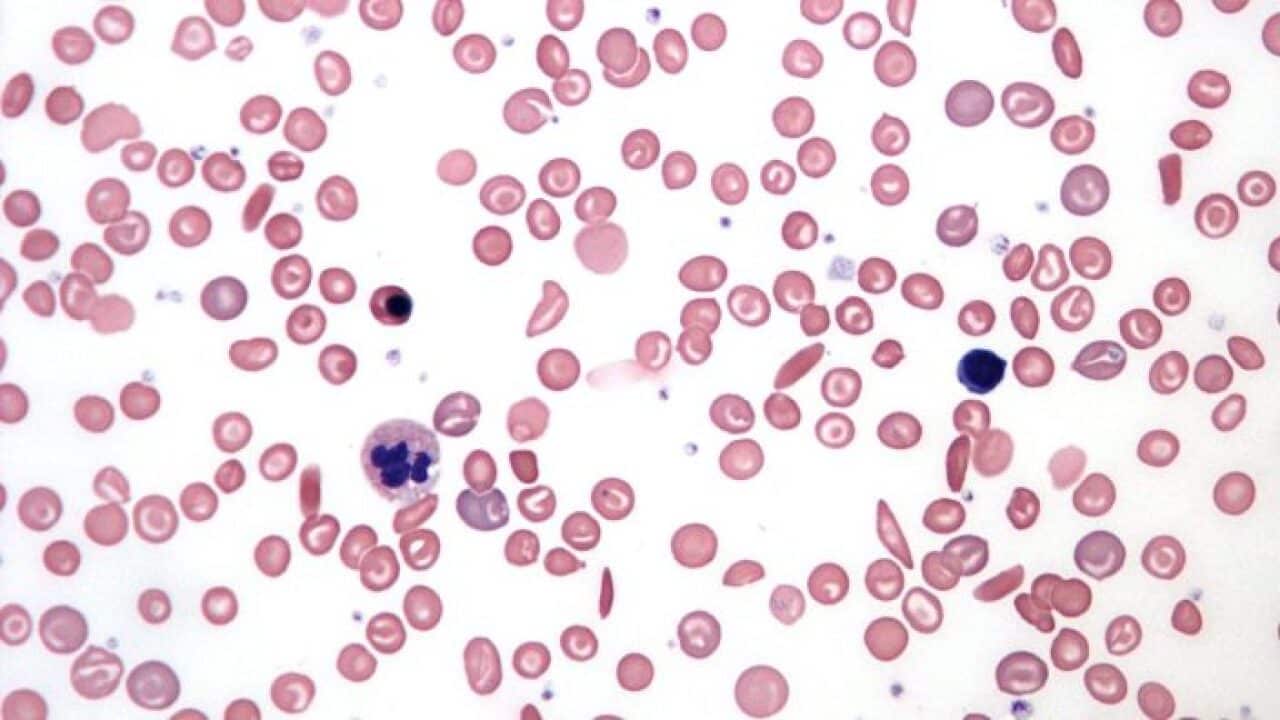 A blood smear showing abnormally shaped red blood cells caused by sickle-cell anemia.