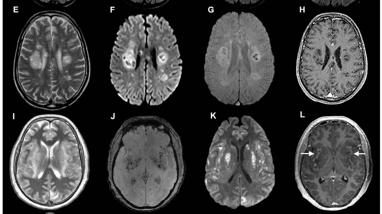 An image provided by Ross W. Paterson, Rachel L. Brown, et al./Brain, Oxford University Press, brain scans of coronavirus patients from a study published in July. The new study offers the first clear evidence that in some people,