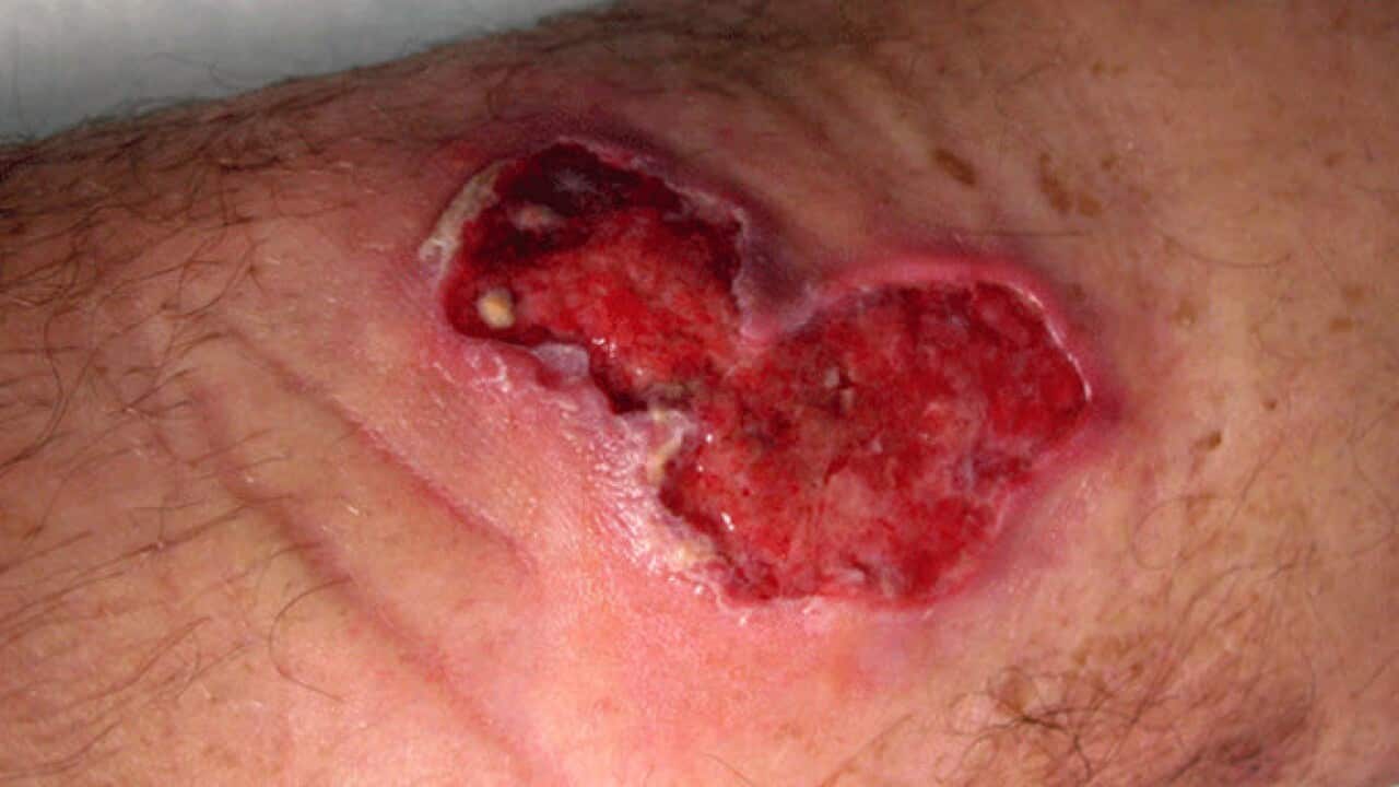 Devastating impact of the buruli ulcer
