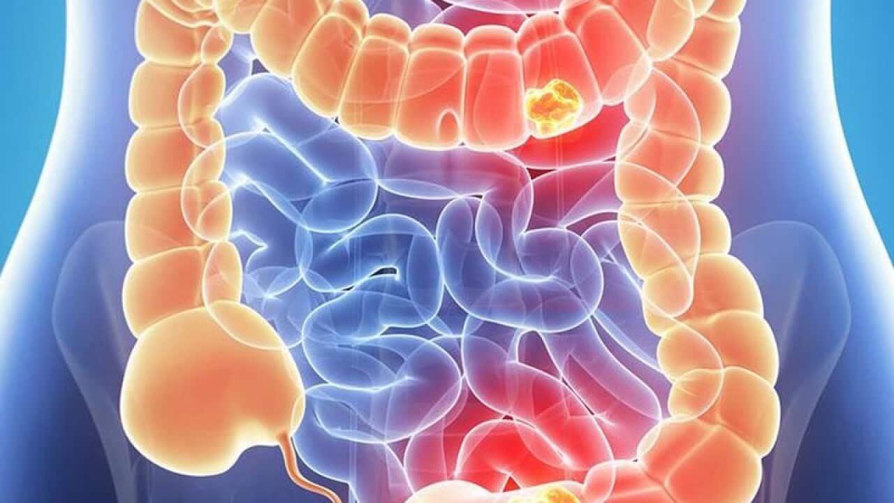 bowel cancer