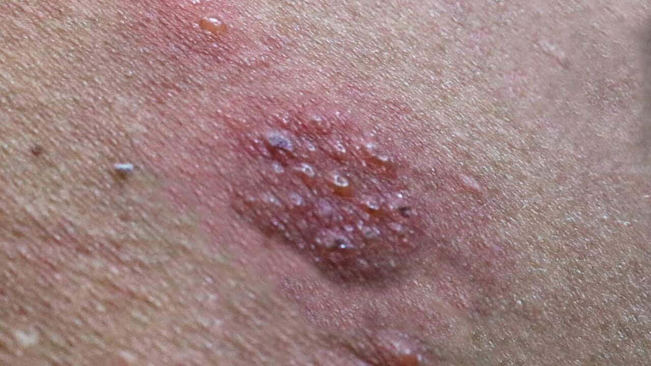 Shingles rash