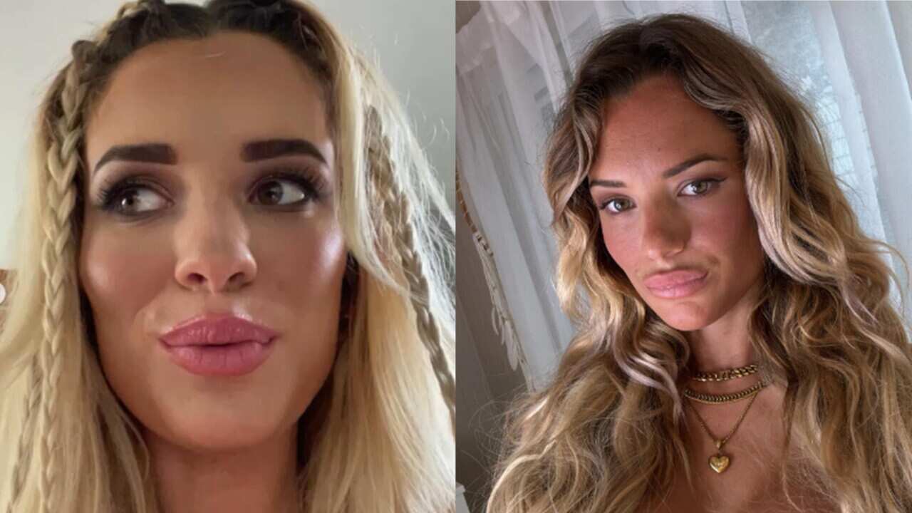 Cosmetic injectables: Is the duck pout out? Why people are ditching the 'Instagram look' - Vimarsana News