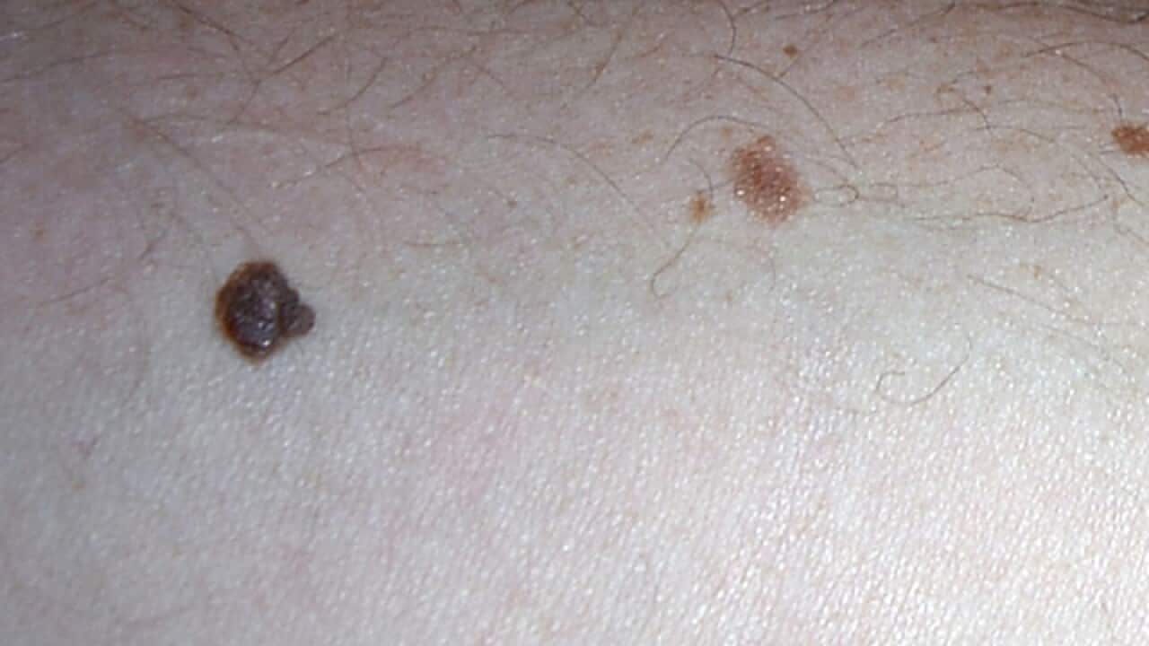 Melanoma patient