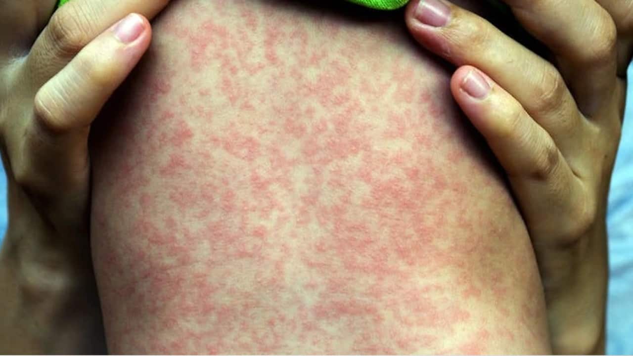 卫生部向悉尼北区居民发出麻疹警告| SBS Chinese