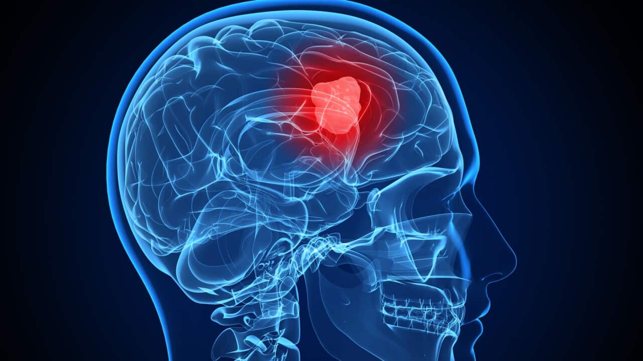 Brain cancer, artwork