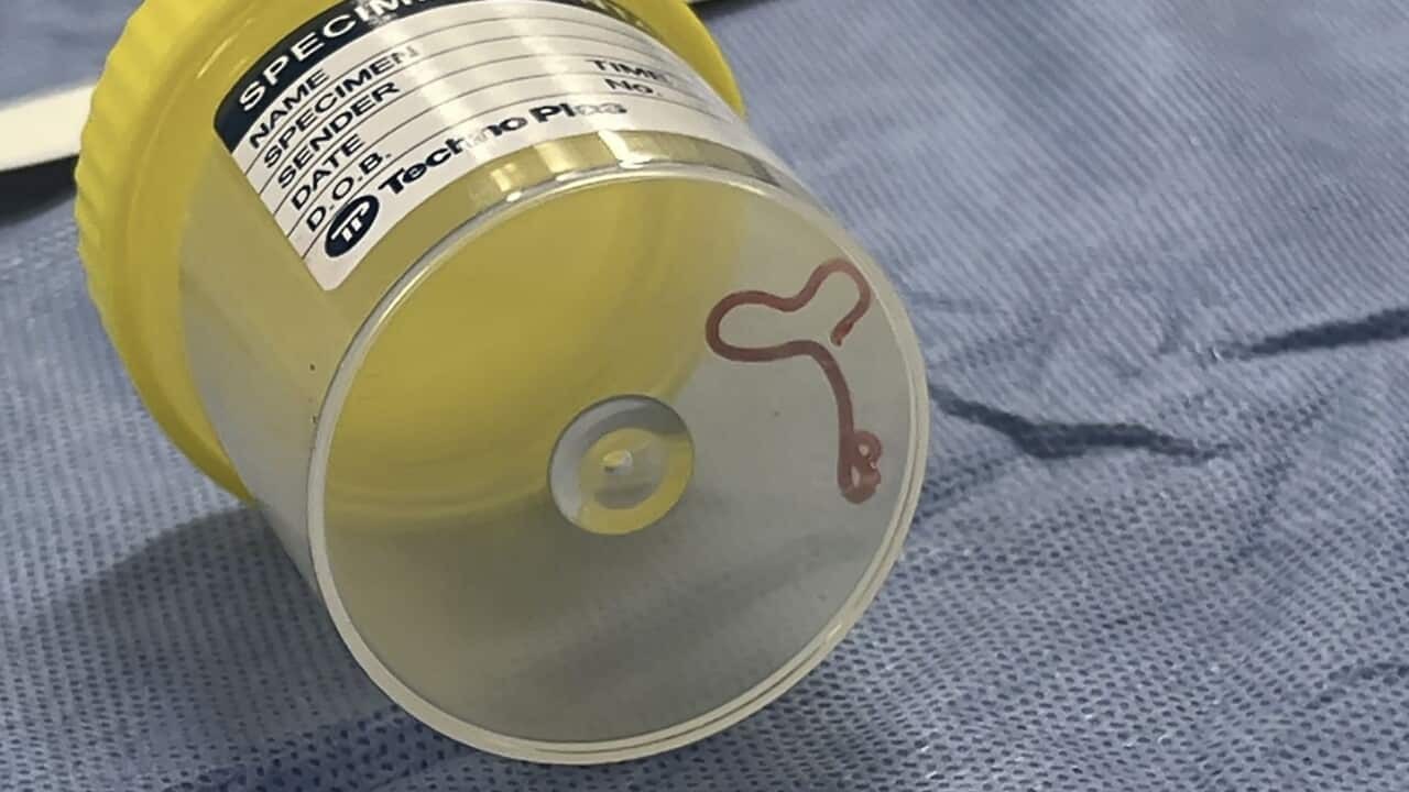 The parasitic worm in a specimen jar at a Canberra hospital (AAP)