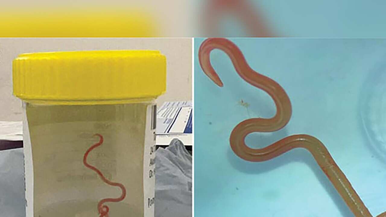 AUSTRALIA PARASITIC INFECTION DISCOVERY