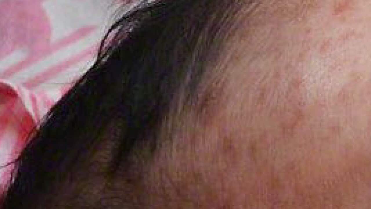 Three NSW measles cases in under a week