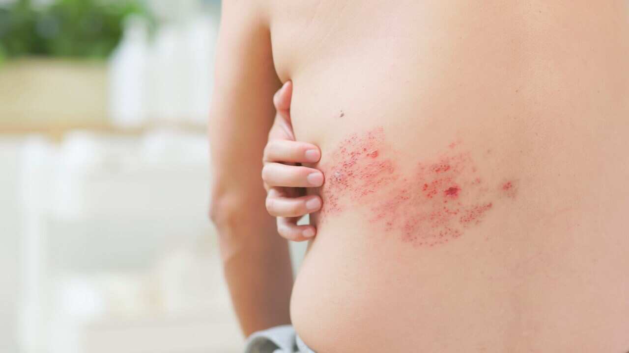 man has shingles disease