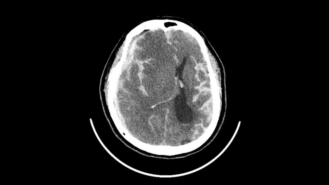 Haemorrhagic stroke, CT scan