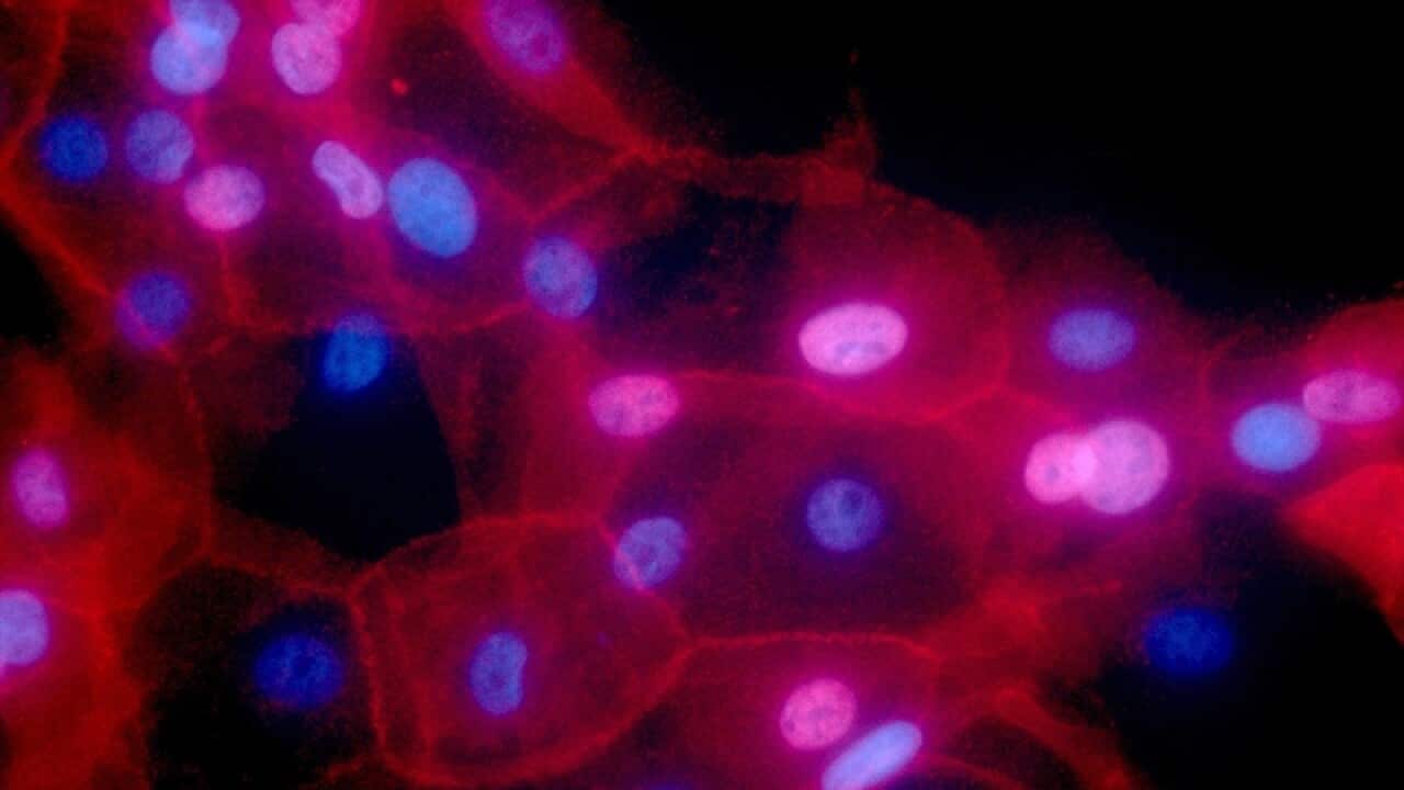 a culture of human breast cancer cells