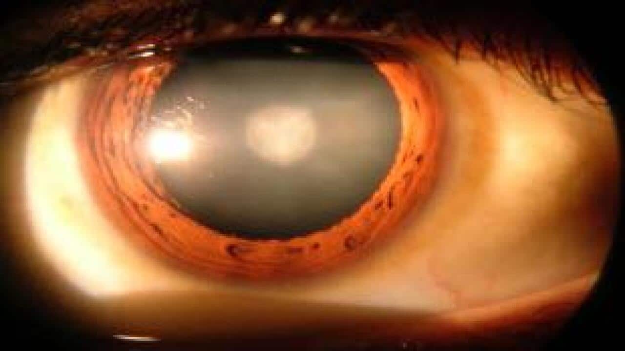Eye with cataract