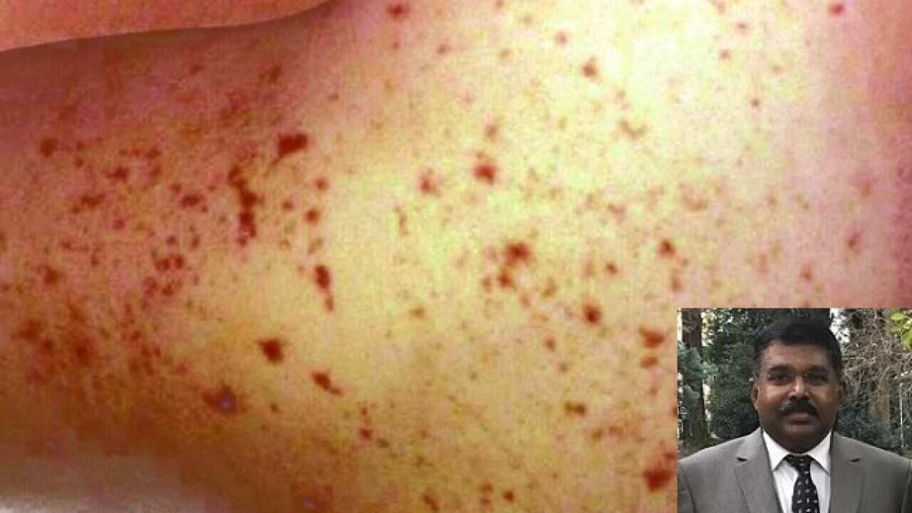 meningococcal