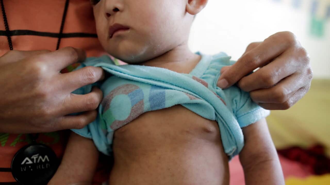 . At least 55 deaths have been recorded since 01 January, mostly children under the age of four, health secretary Francisco Duque III said