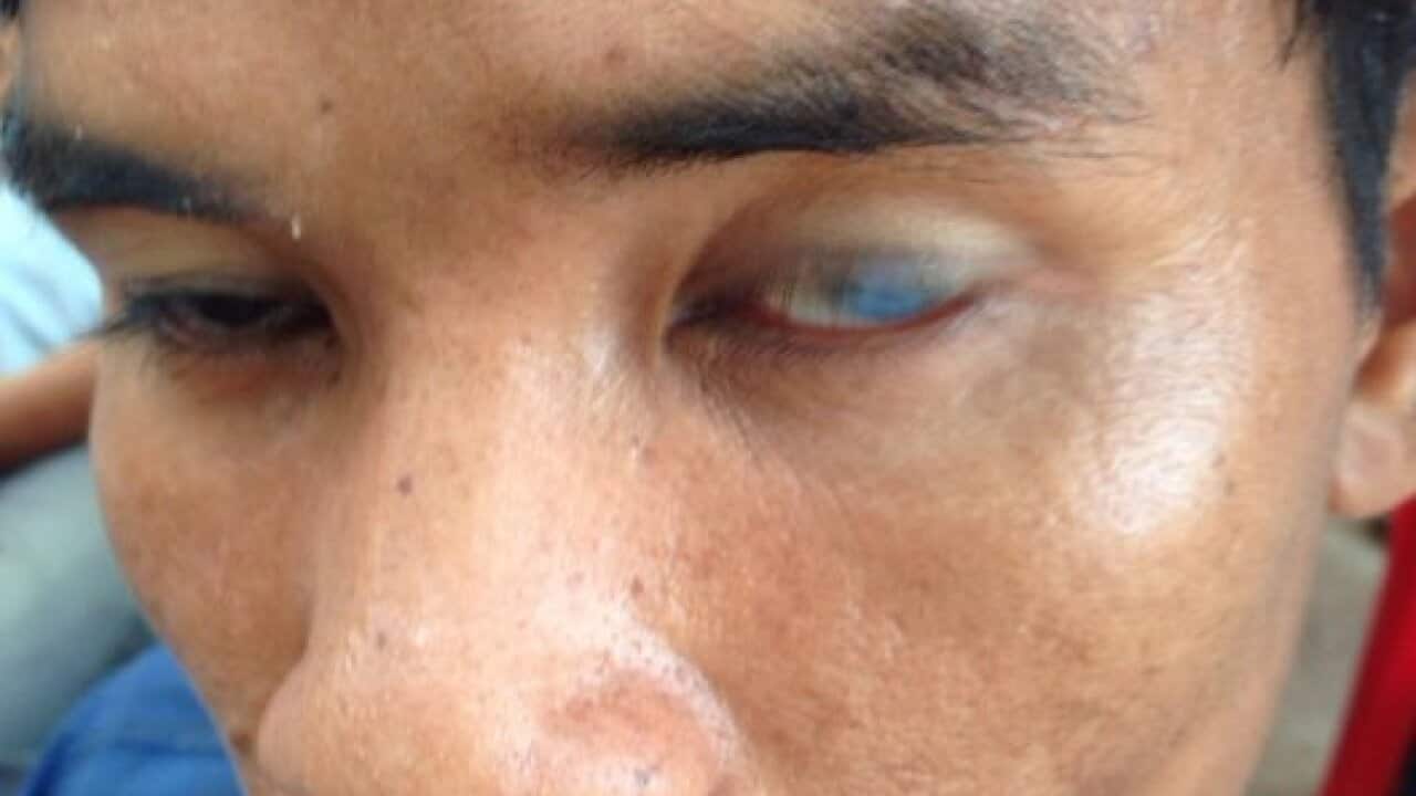 Cataract eye