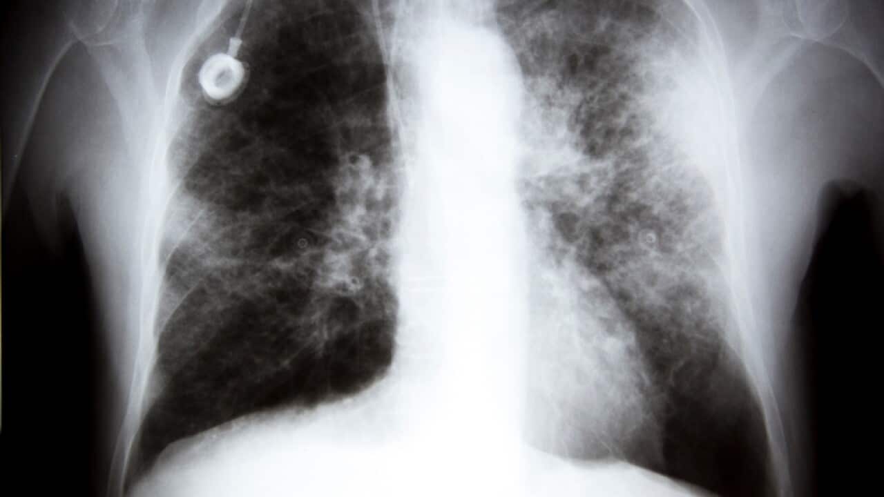 An X-ray showing lung cancer