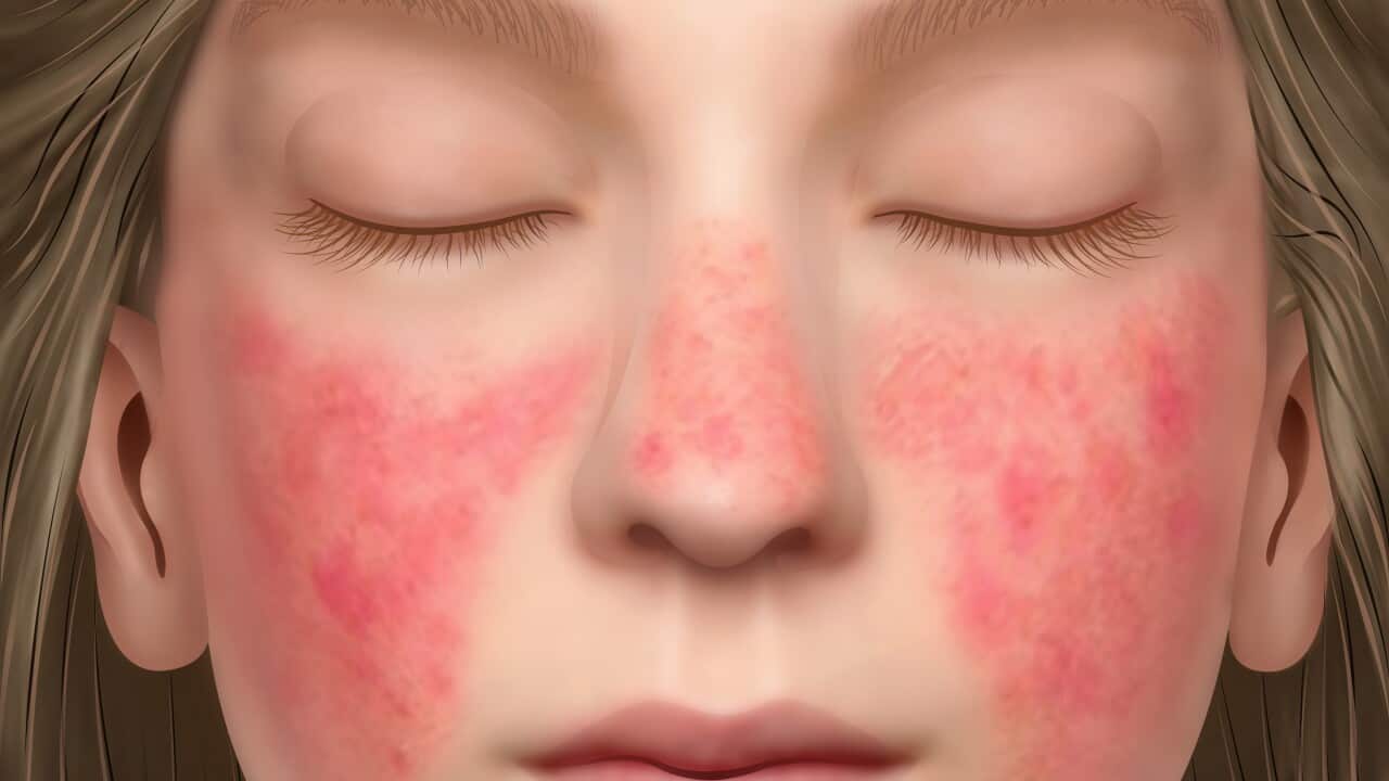 Face with lupus erythematosus, illustration