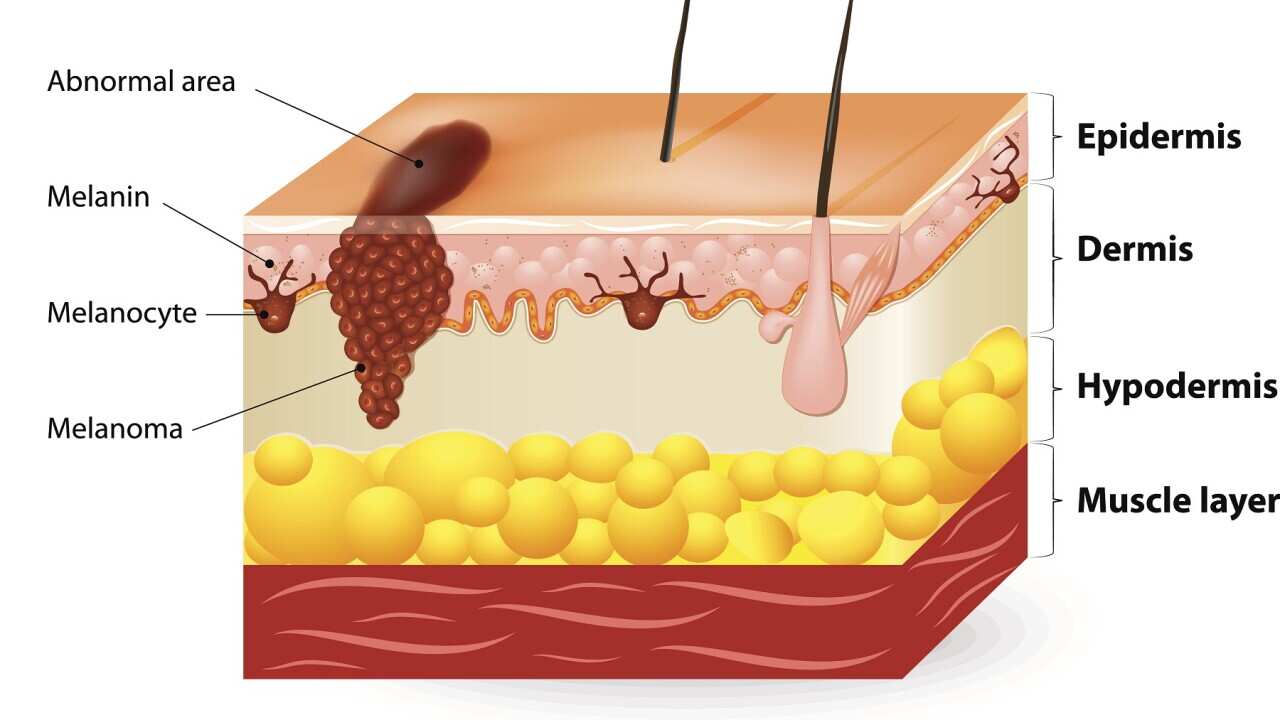 Melanoma or skin cancer