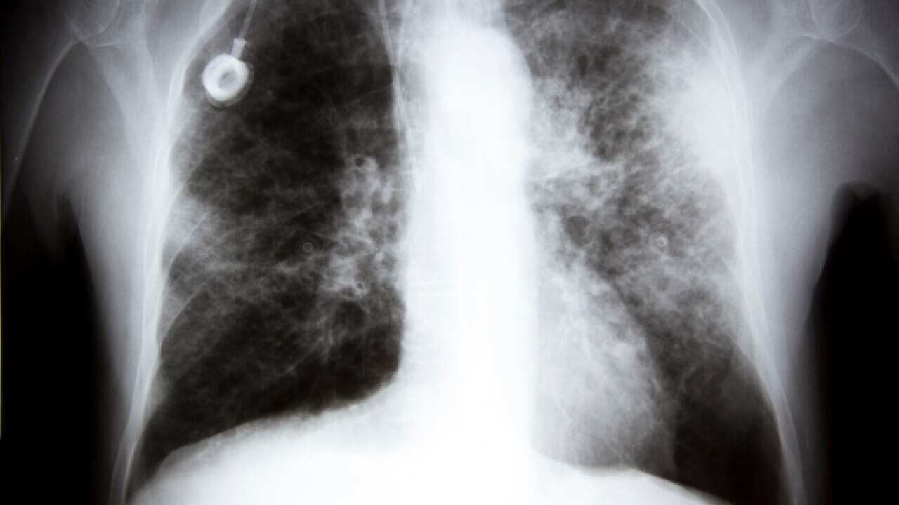 An X-ray showing lung cancer (Getty).