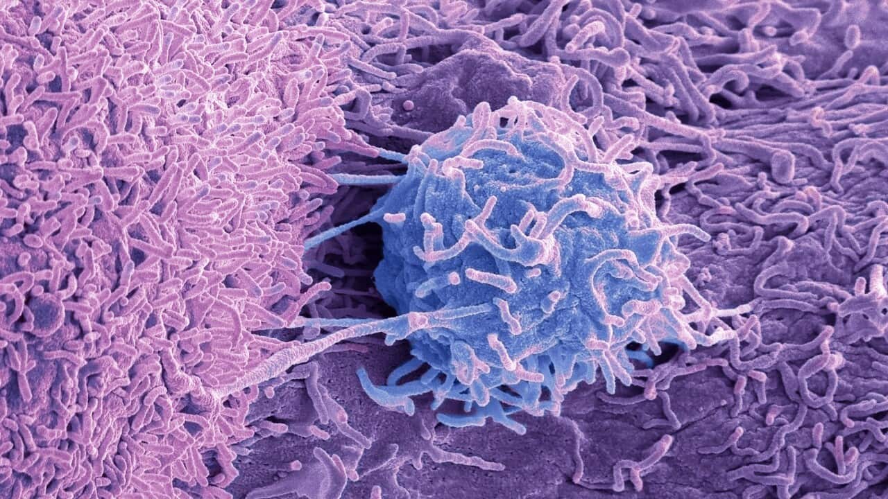 Prostate cancer cells, SEM