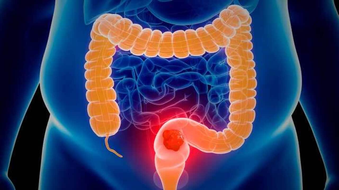 bowel cancer