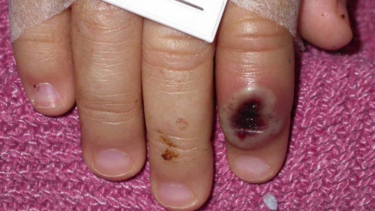 A skin lesion caused by the monkeypox virus (AAP)