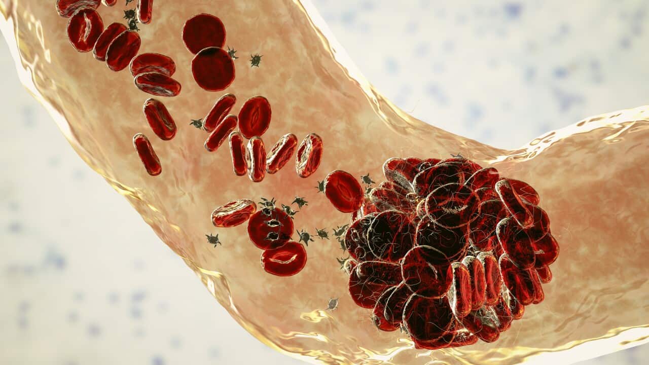 Blood clot, illustration