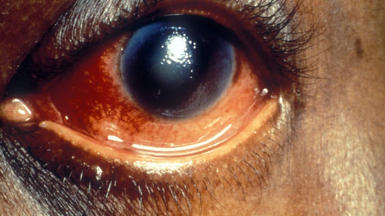 Acute glaucoma. Black bore hyphaema. Corneal oedema.