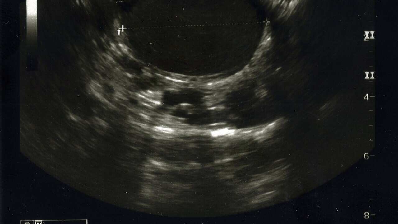 An endometriosis cyst ultrasound scan