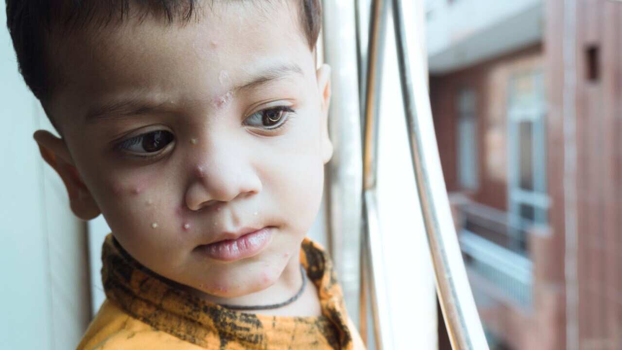 Things you should know about Chickenpox during this Winter season in Australia