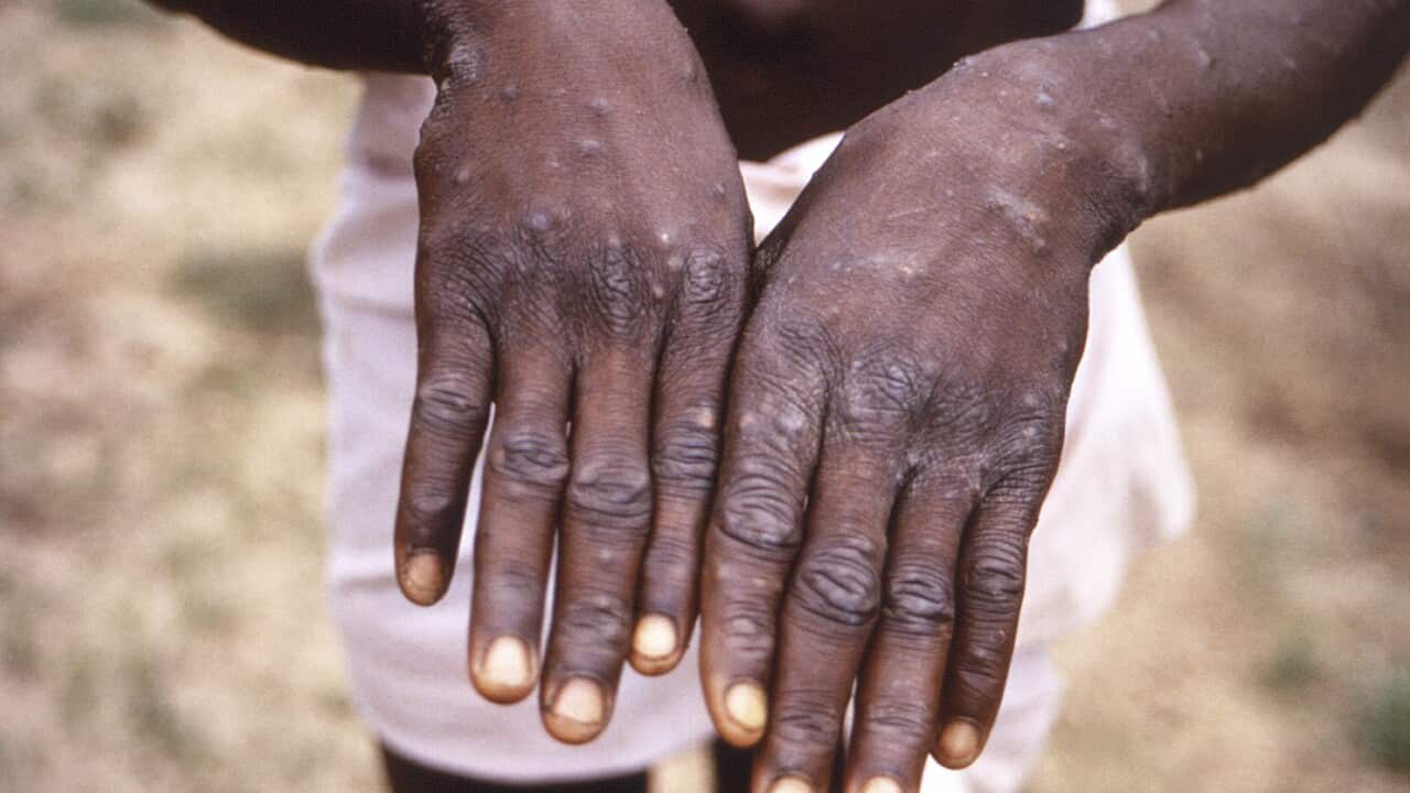 Hands infected with monkeypox virus
