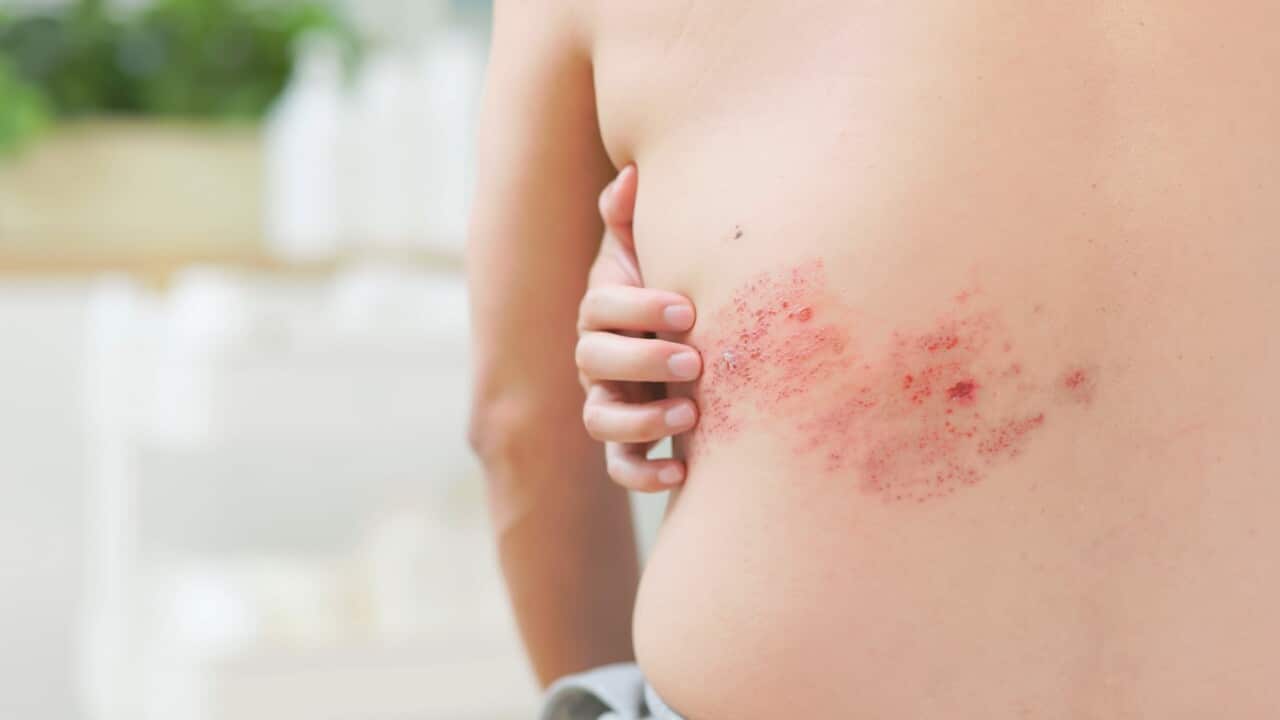 man has shingles disease