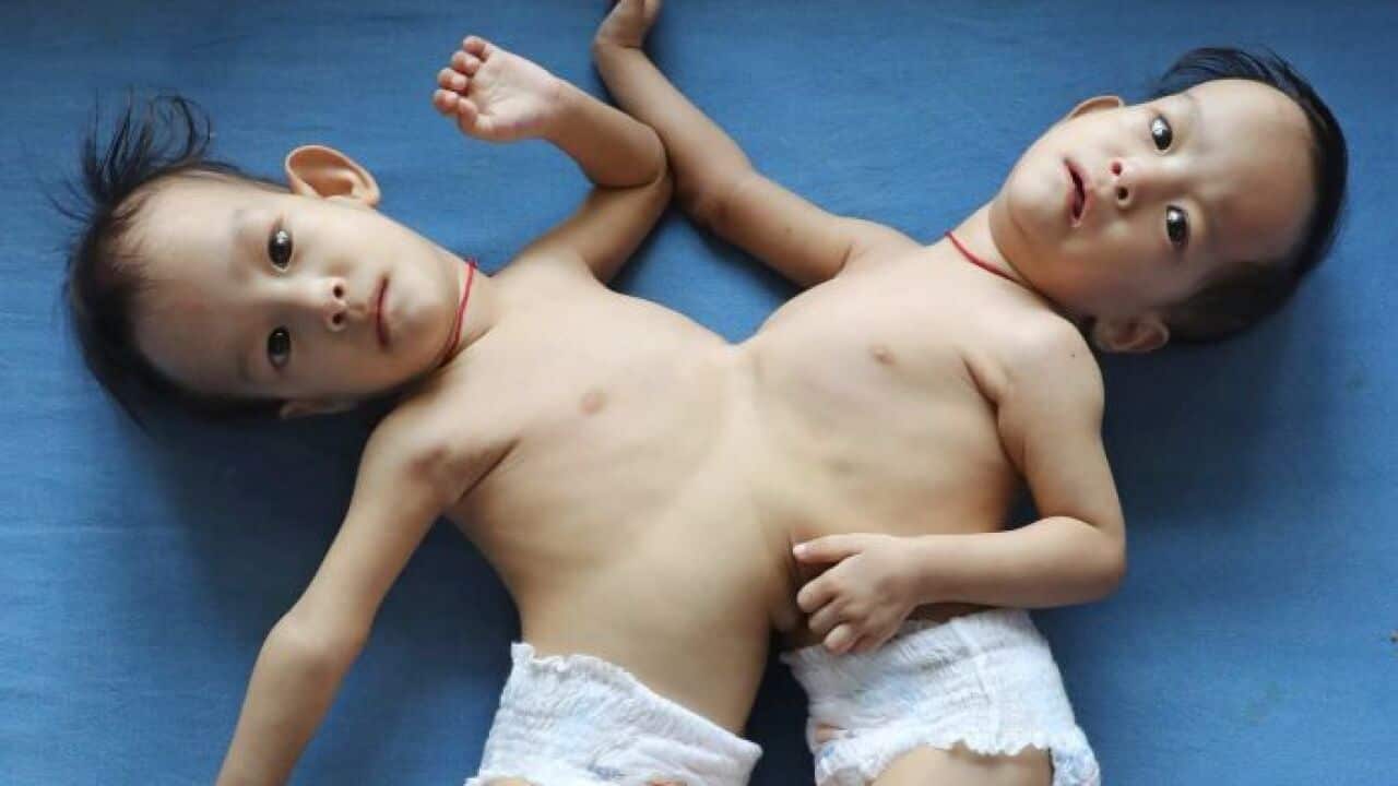 The health of the twins will be assessed before a surgical plan is made.